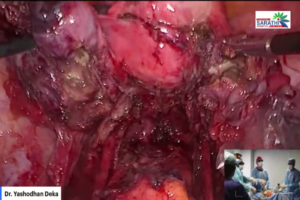 Laparoscopic Cystectomy 