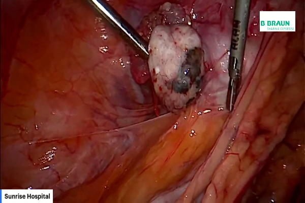 Total Laparoscopic Hysterectomy - Sunrise method