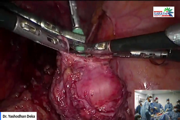 Total Laparoscopic Hysterectomy with Bilateral Salpingo Oophorectomy