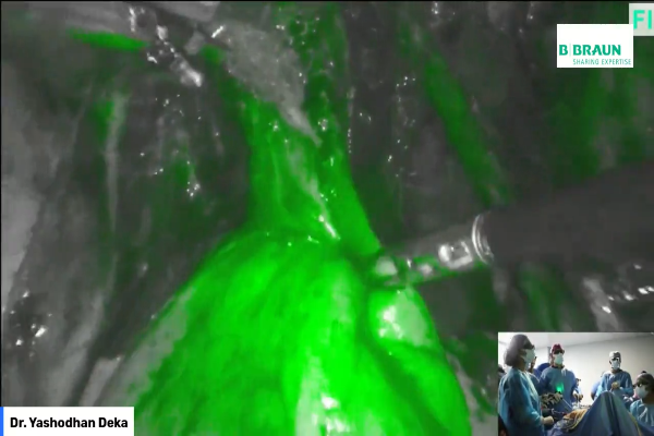 Cyst Excision with Discord Excision for Rectal Nodule