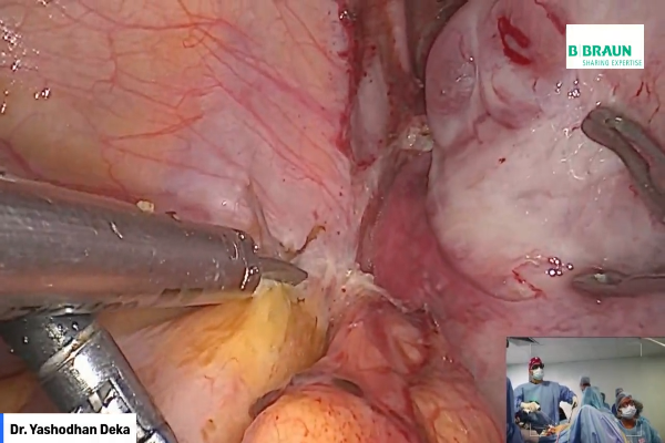 B/l drainage of Endometrioma & fulguration to preserve ovarian reserve